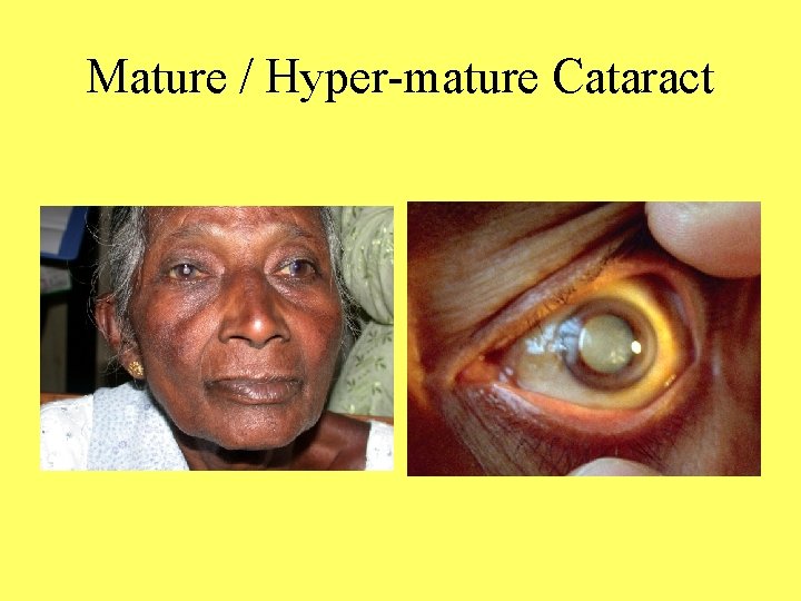 Mature / Hyper-mature Cataract 