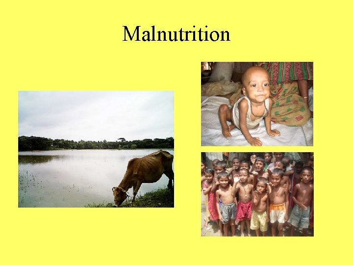 Malnutrition 