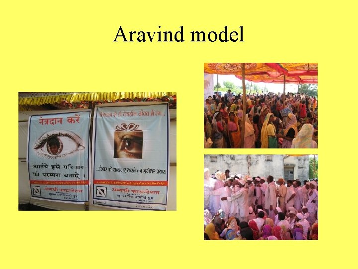 Aravind model 