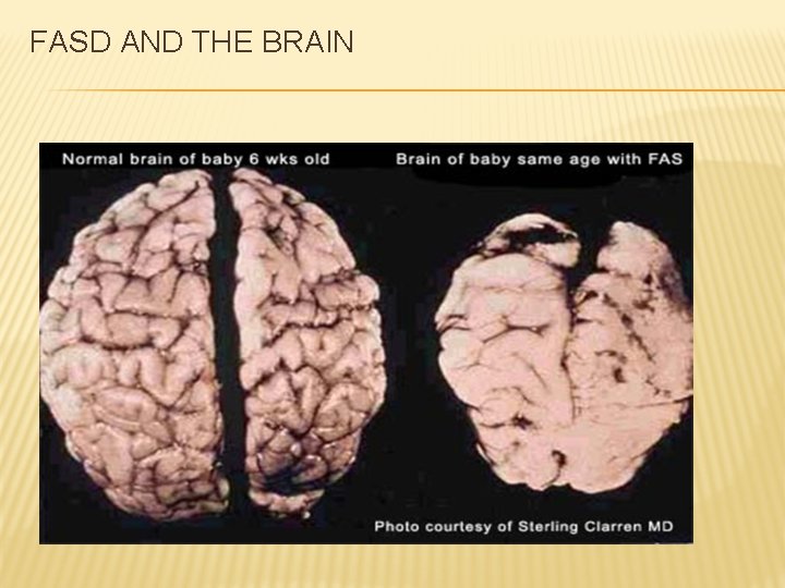  FASD AND THE BRAIN 