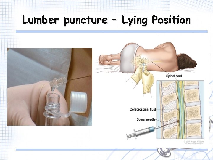 Lumber puncture – Lying Position 