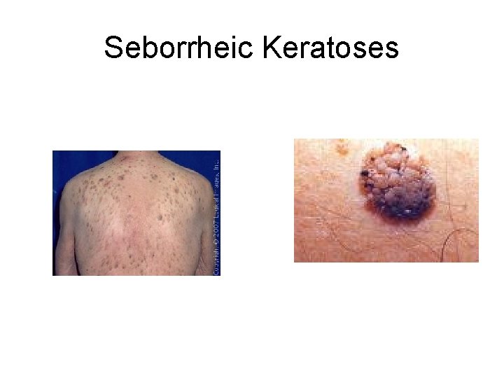 Seborrheic Keratoses 