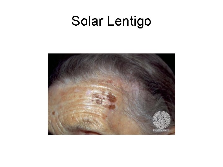 Solar Lentigo 
