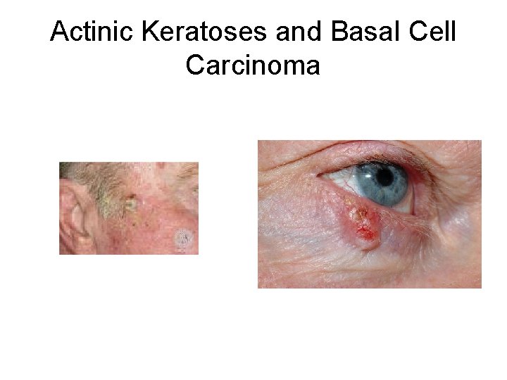 Actinic Keratoses and Basal Cell Carcinoma 