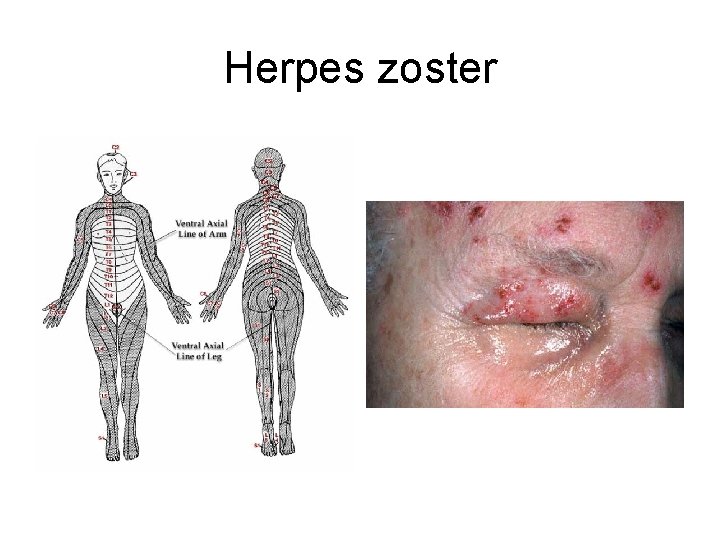 Herpes zoster 