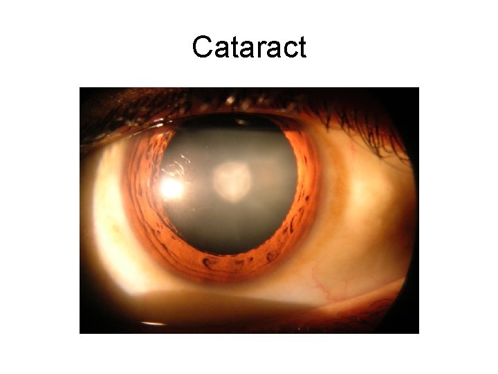 Cataract 
