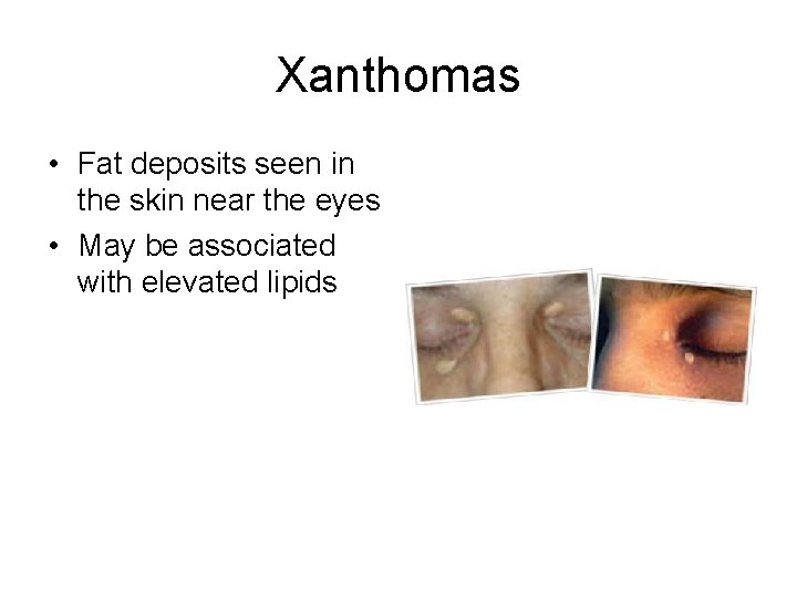 Xanthomas • Fat deposits seen in the skin near the eyes • May be