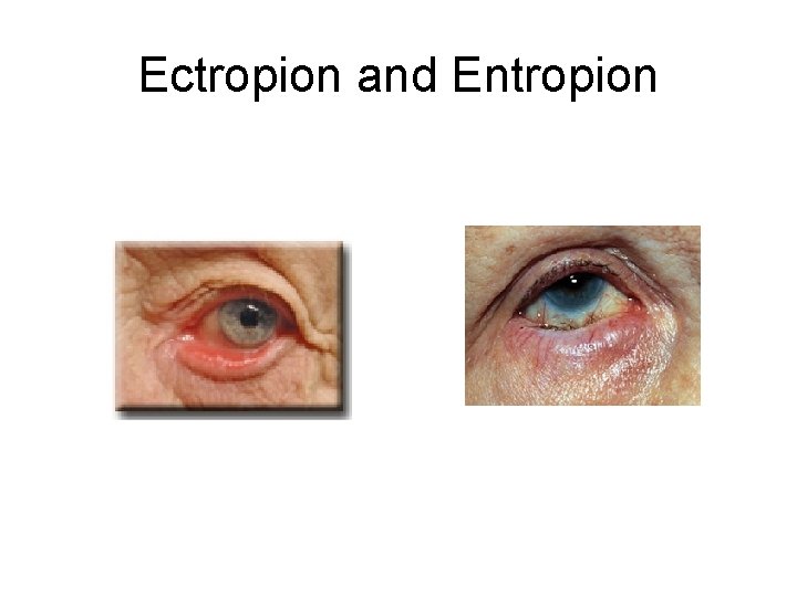 Ectropion and Entropion 