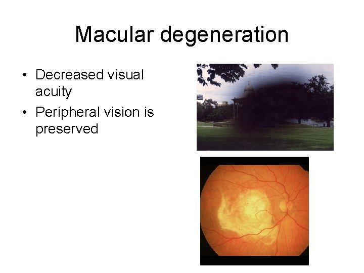 Macular degeneration • Decreased visual acuity • Peripheral vision is preserved 
