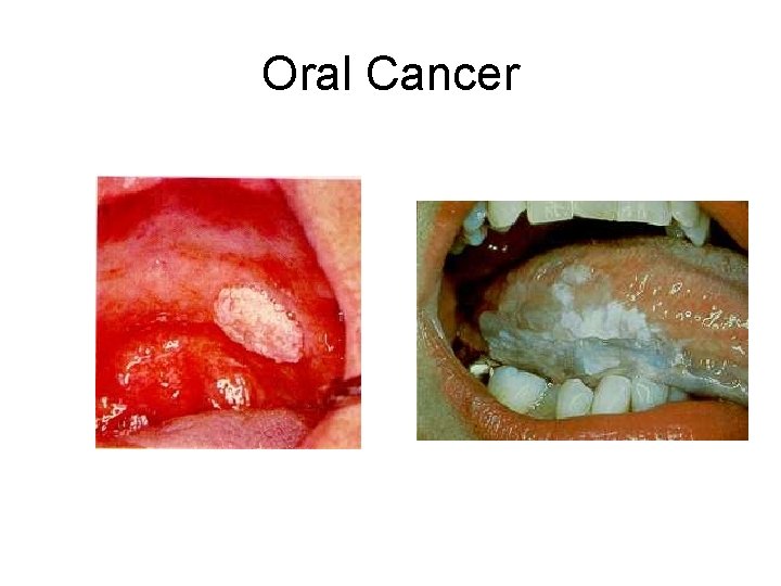 Oral Cancer 