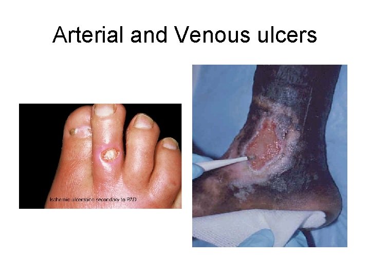 Arterial and Venous ulcers 
