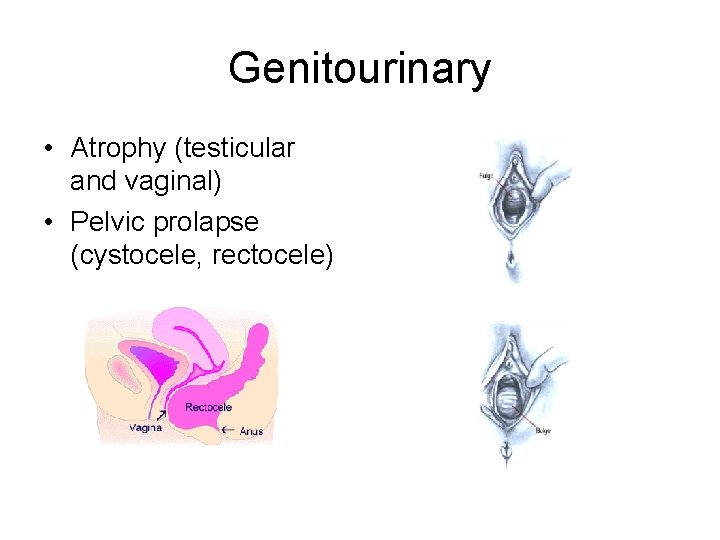 Genitourinary • Atrophy (testicular and vaginal) • Pelvic prolapse (cystocele, rectocele) 