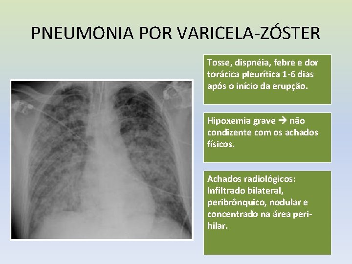 PNEUMONIA POR VARICELA-ZÓSTER Tosse, dispnéia, febre e dor torácica pleurítica 1 -6 dias após