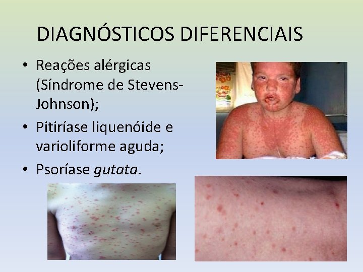 DIAGNÓSTICOS DIFERENCIAIS • Reações alérgicas (Síndrome de Stevens. Johnson); • Pitiríase liquenóide e varioliforme