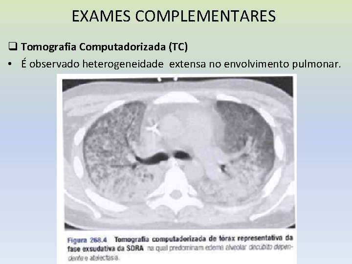 EXAMES COMPLEMENTARES q Tomografia Computadorizada (TC) • É observado heterogeneidade extensa no envolvimento pulmonar.