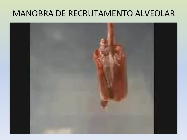 MANOBRA DE RECRUTAMENTO ALVEOLAR 