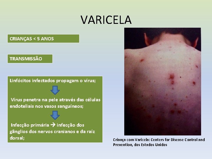 VARICELA CRIANÇAS < 5 ANOS TRANSMISSÃO Linfócitos infectados propagam o vírus; Vírus penetra na