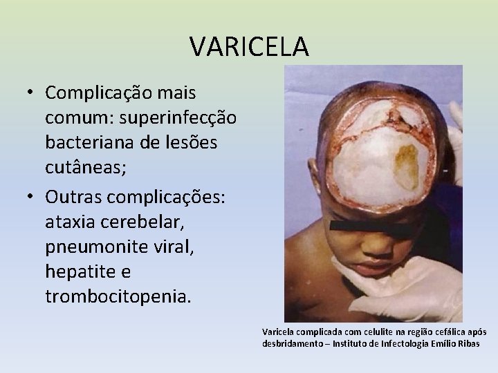 VARICELA • Complicação mais comum: superinfecção bacteriana de lesões cutâneas; • Outras complicações: ataxia