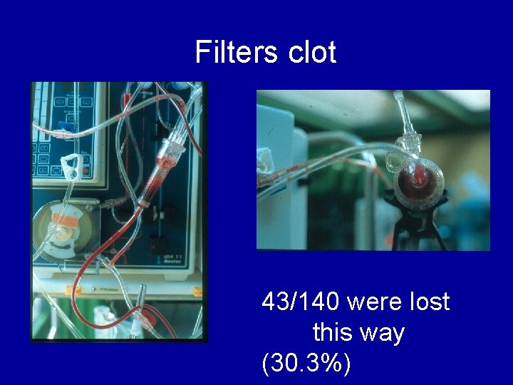 Filters clot 43/140 were lost this way (30. 3%) 