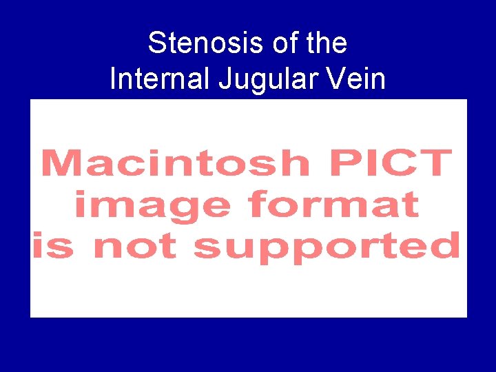 Stenosis of Internal of. Jugular the Vein Internal Jugular Vein 