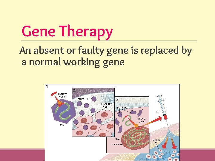 Gene Therapy An absent or faulty gene is replaced by a normal working gene