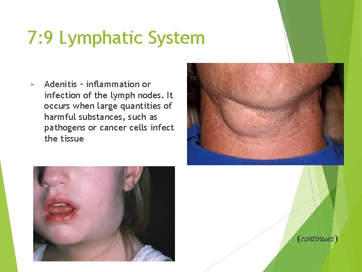 7: 9 Lymphatic System ▶ Adenitis – inflammation or infection of the lymph nodes.