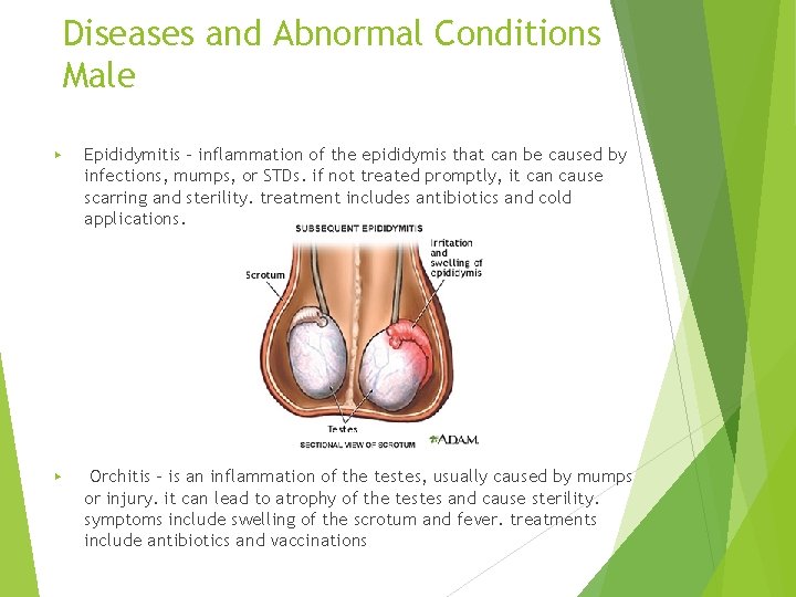 Diseases and Abnormal Conditions Male ▶ Epididymitis – inflammation of the epididymis that can