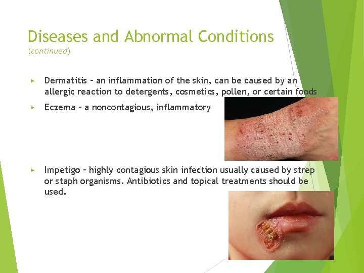 Diseases and Abnormal Conditions (continued) ▶ Dermatitis – an inflammation of the skin, can