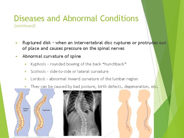 Diseases and Abnormal Conditions (continued) ▶ Ruptured disk – when an intervertebral disc ruptures