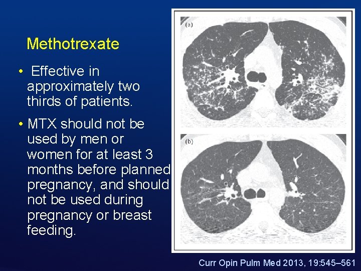 Methotrexate • Effective in approximately two thirds of patients. • MTX should not be