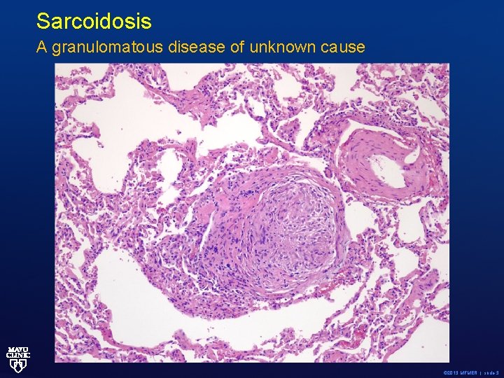 Sarcoidosis A granulomatous disease of unknown cause © 2013 MFMER | slide-3 