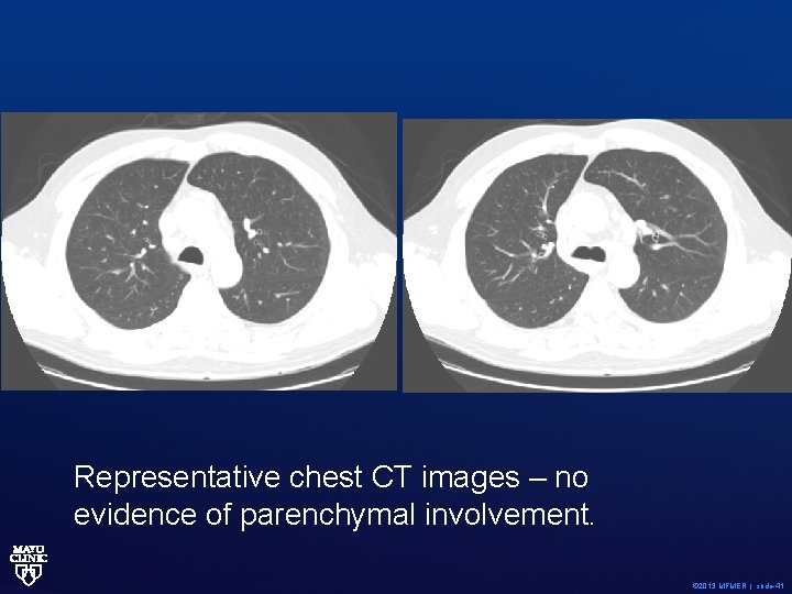 Representative chest CT images – no evidence of parenchymal involvement. © 2013 MFMER |