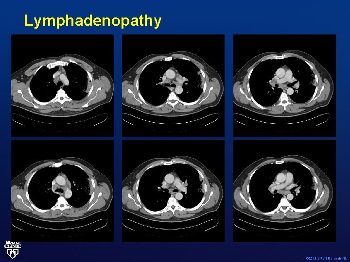 Lymphadenopathy © 2013 MFMER | slide-42 