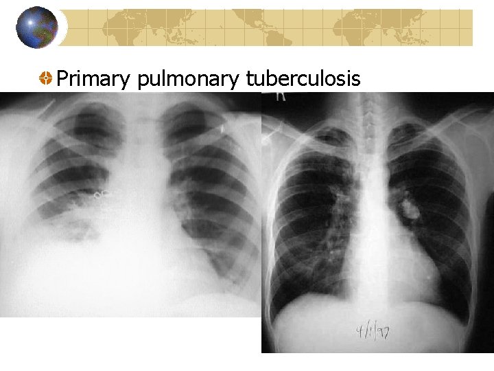 Primary pulmonary tuberculosis 