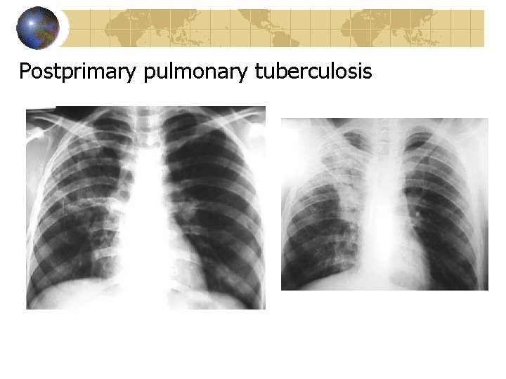 Postprimary pulmonary tuberculosis 