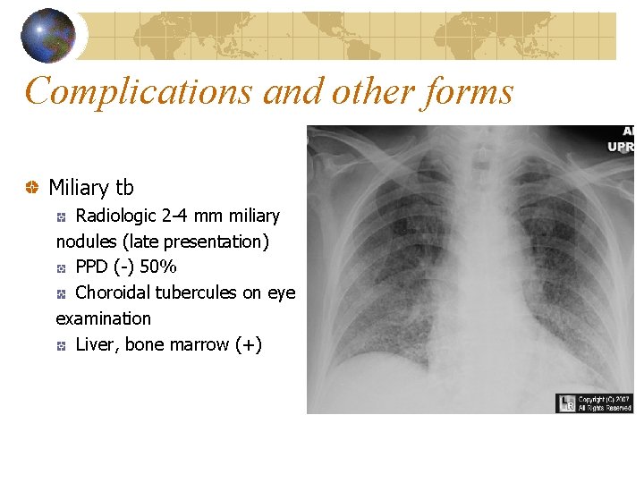 Complications and other forms Miliary tb Radiologic 2 -4 mm miliary nodules (late presentation)