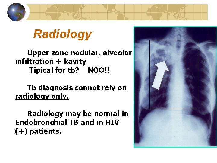 Radiology Upper zone nodular, alveolar infiltration + kavity Tipical for tb? NOO!! Tb diagnosis