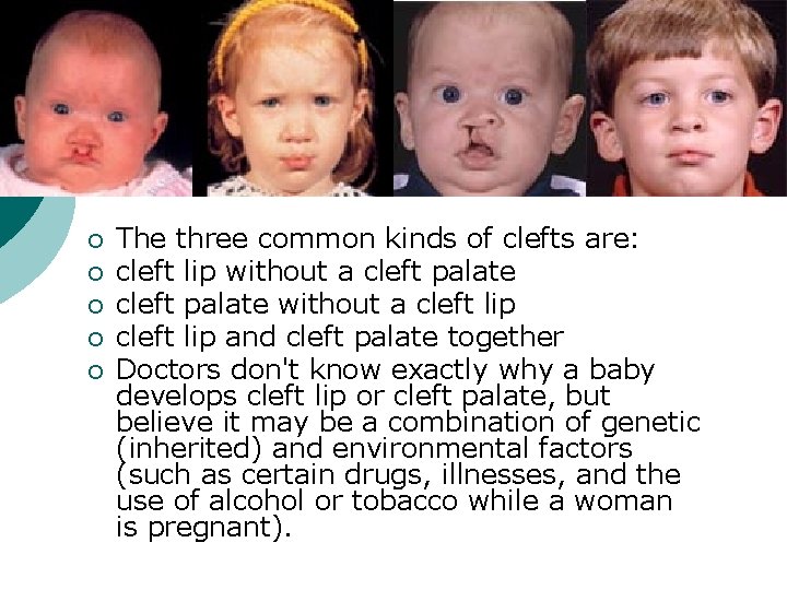 ¡ ¡ ¡ The three common kinds of clefts are: cleft lip without a