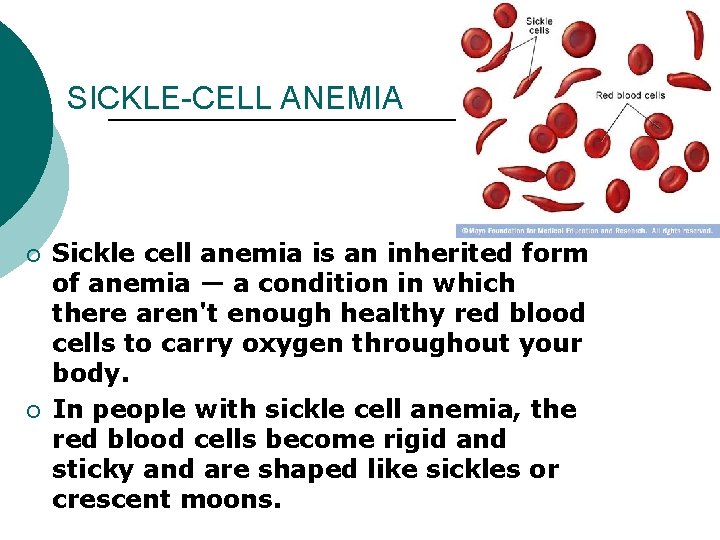 SICKLE-CELL ANEMIA ¡ ¡ Sickle cell anemia is an inherited form of anemia —