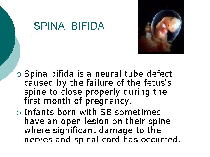 SPINA BIFIDA Spina bifida is a neural tube defect caused by the failure of
