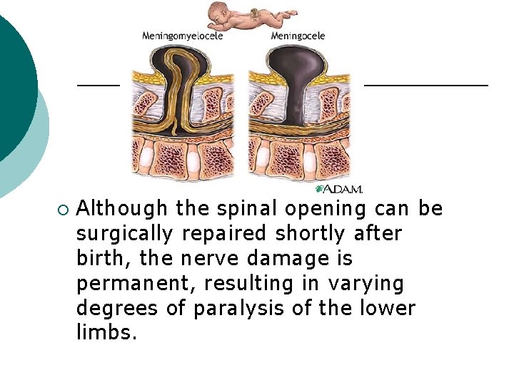 ¡ Although the spinal opening can be surgically repaired shortly after birth, the nerve