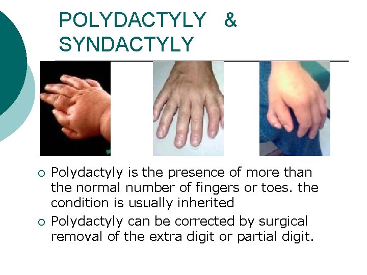 POLYDACTYLY & SYNDACTYLY ¡ ¡ Polydactyly is the presence of more than the normal