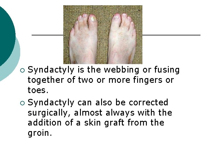 Syndactyly is the webbing or fusing together of two or more fingers or toes.