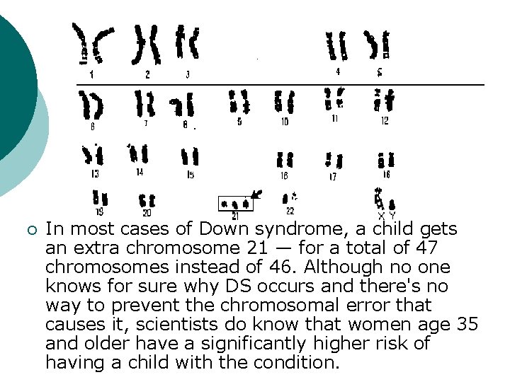 ¡ In most cases of Down syndrome, a child gets an extra chromosome 21