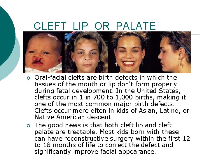 CLEFT LIP OR PALATE ¡ ¡ Oral-facial clefts are birth defects in which the