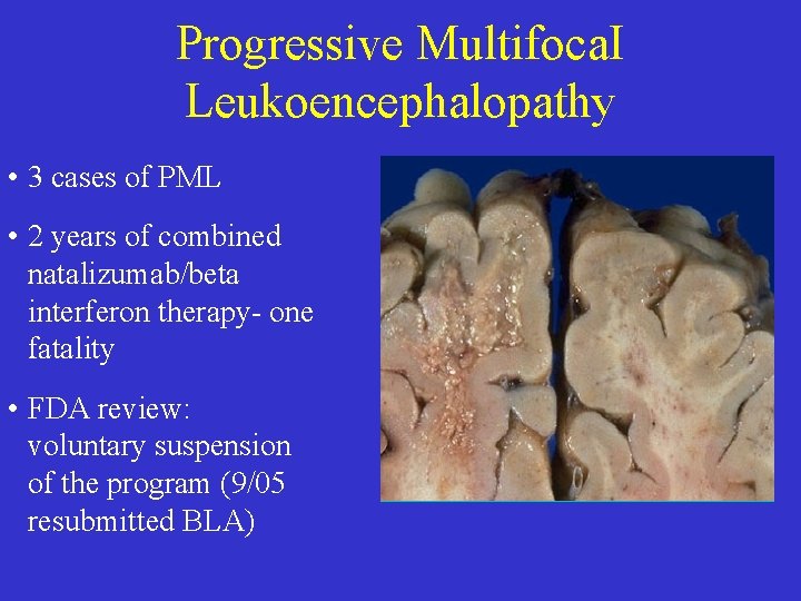 Progressive Multifoca. I Leukoencephalopathy • 3 cases of PML • 2 years of combined Progressive Multifoca. I Leukoencephalopathy • 3 cases of PML • 2 years of combined