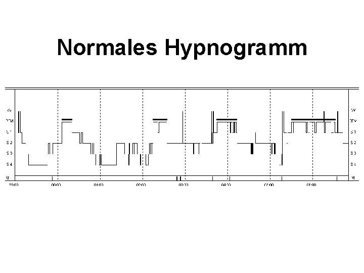 Normales Hypnogramm 