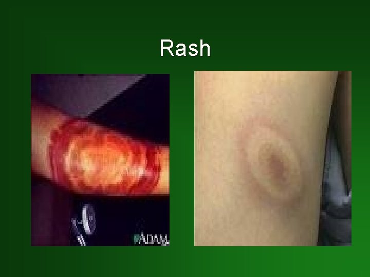 Rash 