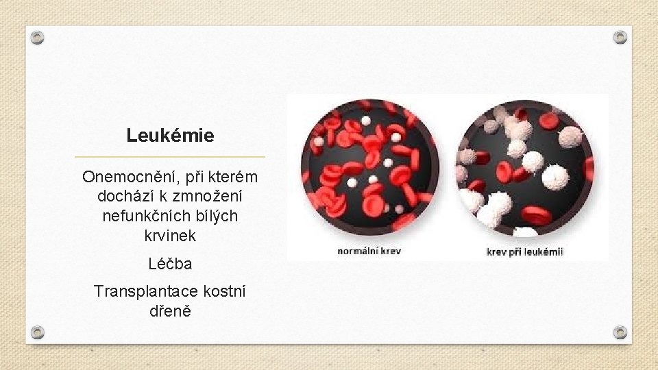 Leukémie Onemocnění, při kterém dochází k zmnožení nefunkčních bílých krvinek Léčba Transplantace kostní dřeně