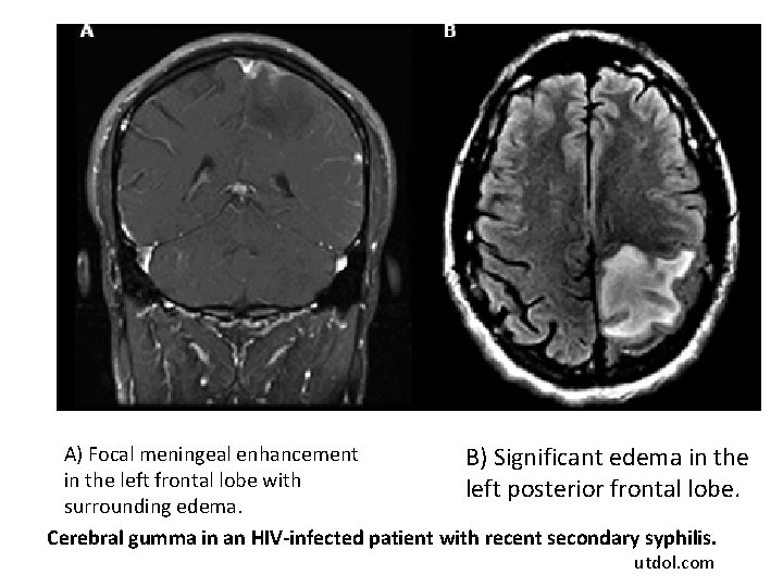 A) Focal meningeal enhancement B) Significant edema in the left frontal lobe with left